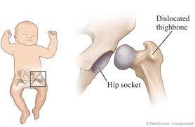 Hip Problems in child