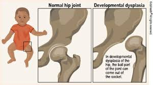 Hip Problems in child