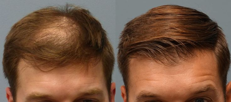 Hair Transplant Treatment in Mumbai 